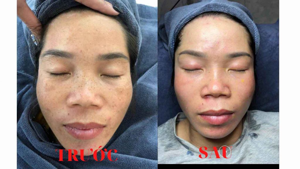 Điều trị Đồi Môi, Nám Mãng, Nám Chân Sâu