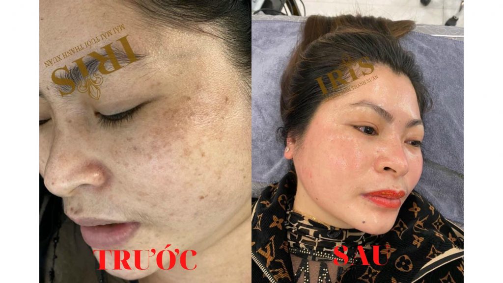 Trước và sau khi điều trị và sử dụng siêu phẩm Iris Gold