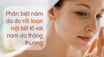 Phân biệt nám da do nội tiết tố và nám da thông thường