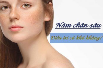 Nám chân sâu điều trị có khó không?