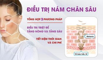 Nám mãng trị có khó không và nên dùng phương pháp nào?